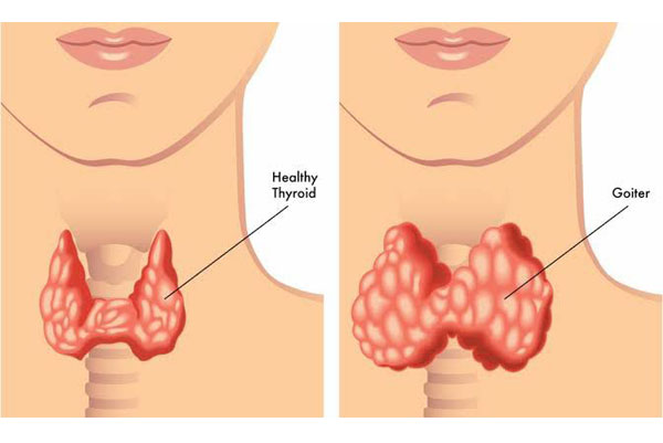 Hypothyroidism