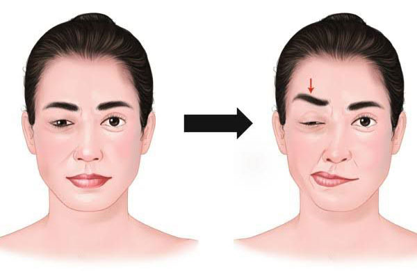 hamifacial1