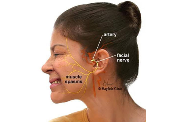 hamifacial1