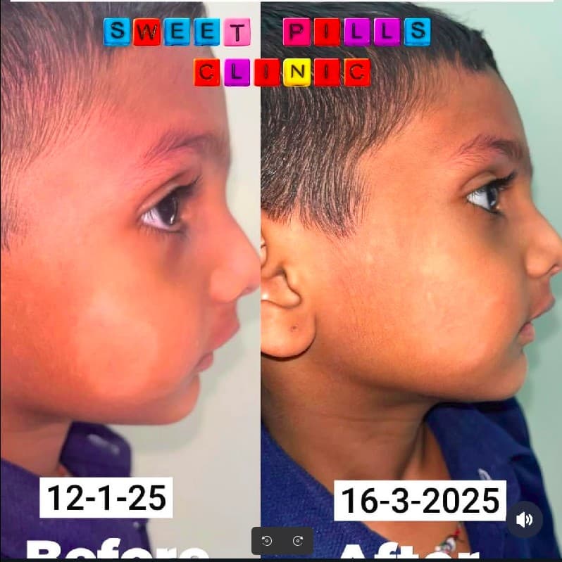 Before and after — child's cheek healing at Sweet Pills Clinic