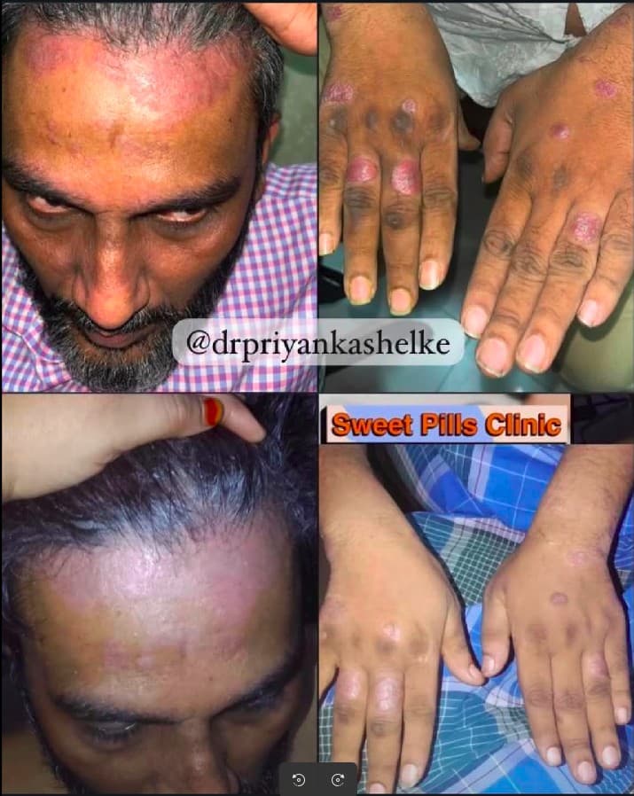 Before and after — cracked heels healed at Sweet Pills Clinic